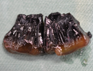 胆嚢粘液腫2.JPG